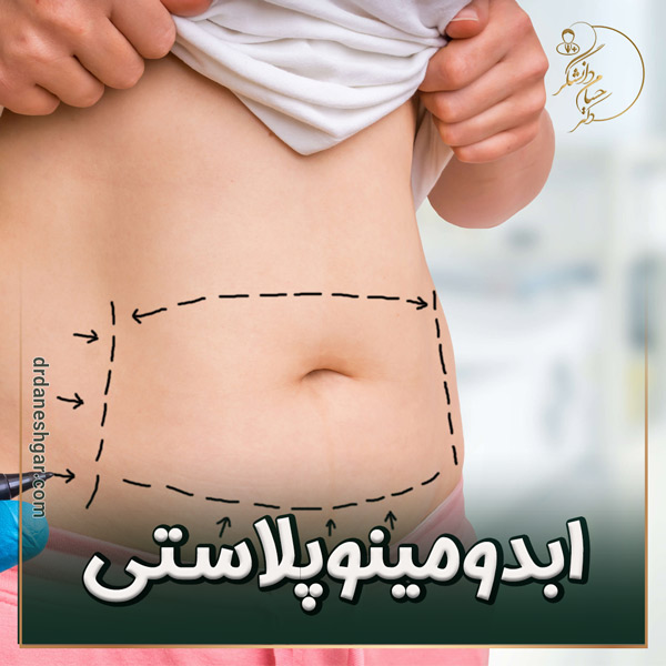 ابدومینوپلاستی - دکتر حسام دانشگر