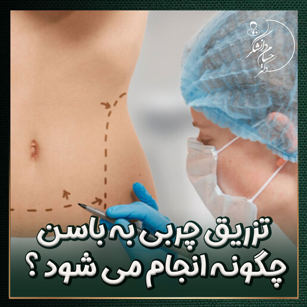 تزریق چربی چگونه انجام می شود