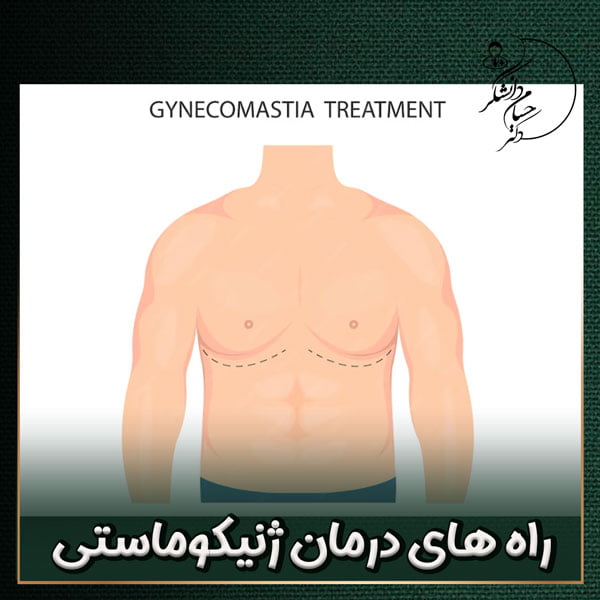 راه های درمان ژنیکوماستی