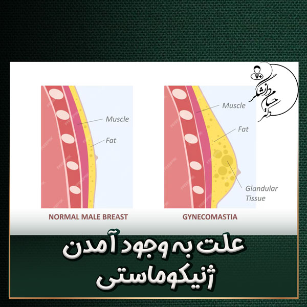 علت به وجود آمدن ژنیکوماستی