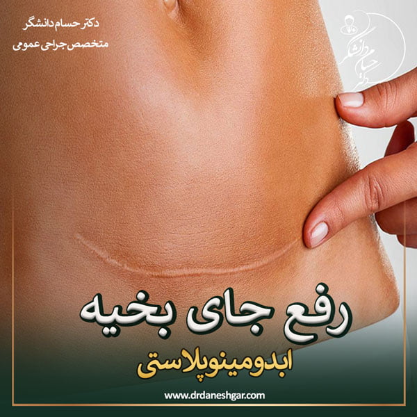 رفع جای بخیه ابدومینوپلاستی - دکتر حسام دانشگر
