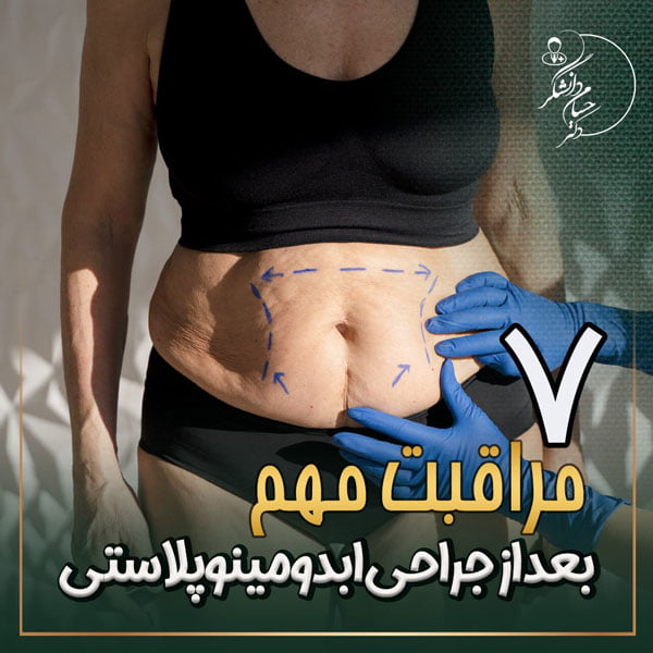 مراقبت های بعد از ابدومینوپلاستی - دکتر دانشگر