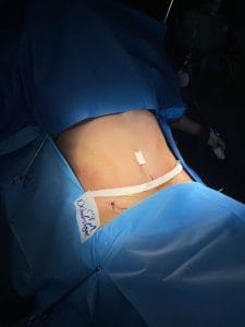 تصویر جراحی لیپوساشکن _ دکتر سید حسام دانشگر
