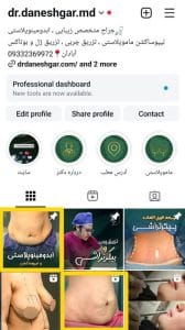 اینستاگرام بهترین دکتر لیپوساکشن _ آبادان 