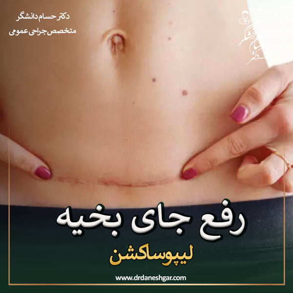 رفع جای بیخیه لیپوساشکن - دکتر سید حسام دانشگر