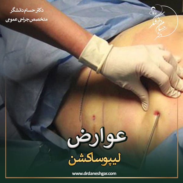 عوارض جراحی لیپوساکشن _ دکتر سید حسام دانشگر