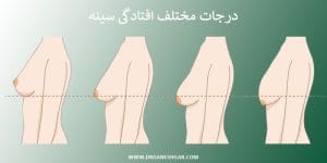 عمل لیفت سینه در ابادان _ دکتر سید حسام دانشگر