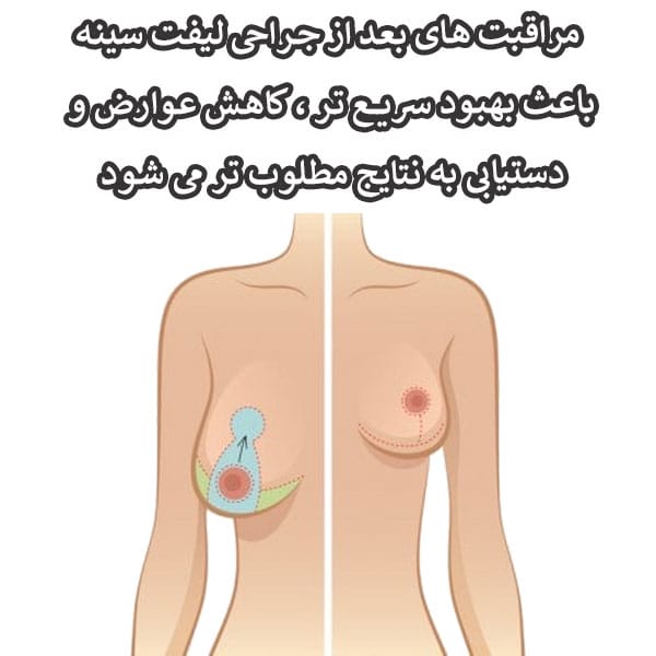 مراقبت های بعد از جراحی لیفت سینه _ دکتر سید حسام دانشگر
