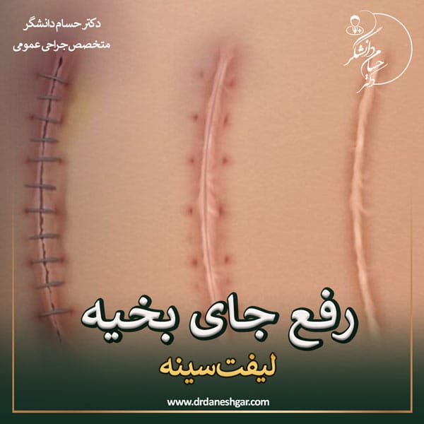 روش های رفع جای بخیه لیفت سینه _ دکتر سید حسام دانشگر