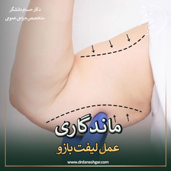 ماندگاری عمل لیفت بازو _ دکتر سید حسام دانشگر