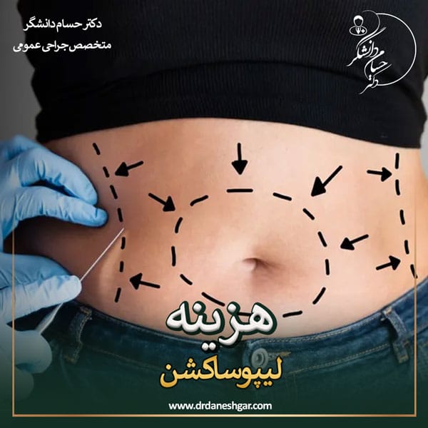 هزینه لیپوساکشن _ سید حسام دانشگر