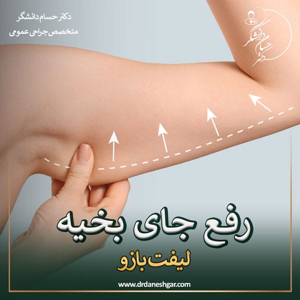 رفع جای بخیه عمل لیفت بازو _ دکتر سید حسام دانشگر